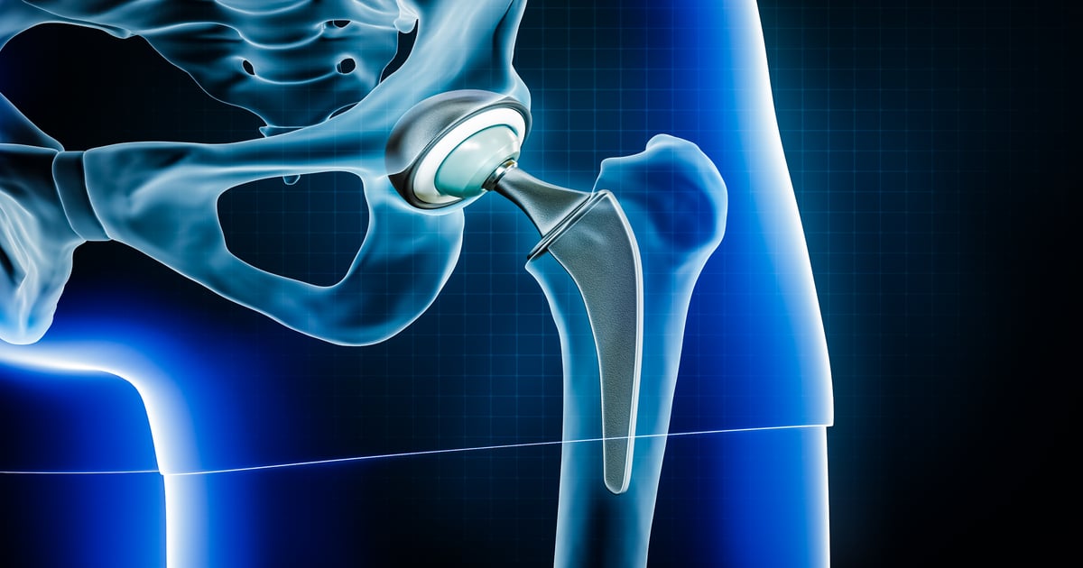 J&J Said to Be Prepping Sale of Orthopedics Unit, DePuy Synthes