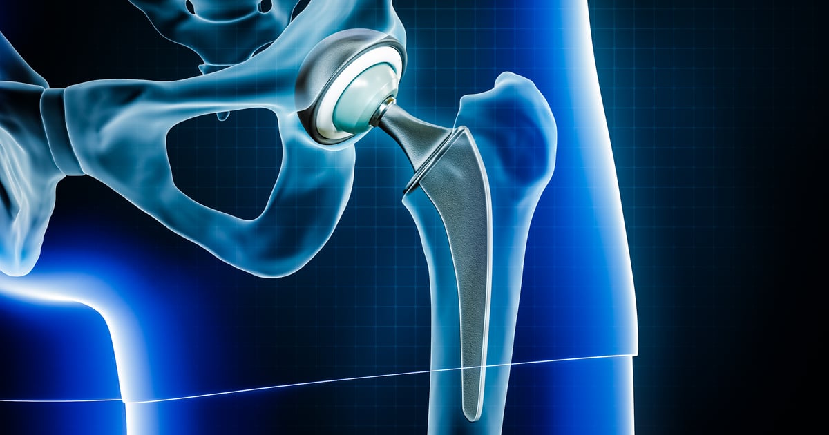 Disable Hips J&J Said to Be Prepping Sale of Orthopedics Unit, DePuy Synthes