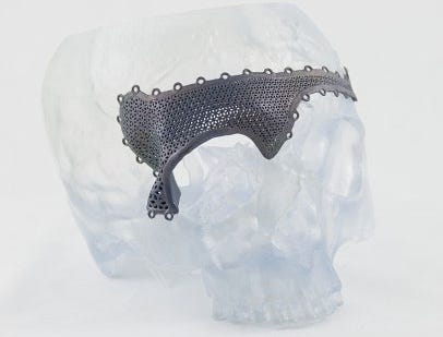 Materialise cranial implant 3-D printing