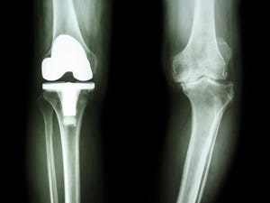 Demystifying Comprehensive Care for Joint Replacement: Gainsharing and Risk