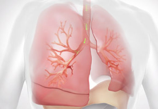 Giving Emphysema Patients a Chance to Breathe