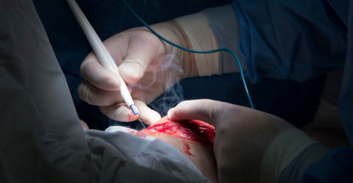 close up photo of a surgeon using an electrosurgery instrument on a patient's wound in the operating room..png