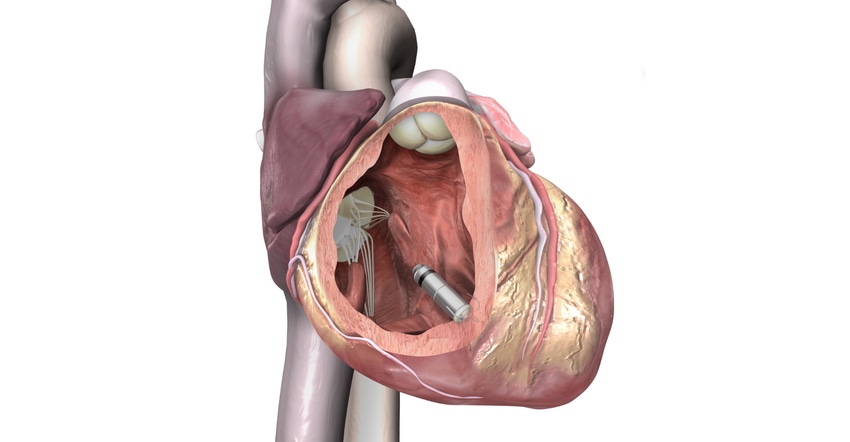 Photo illustration of a Medtronic Micra leadless pacemaker implanted inside a human heart