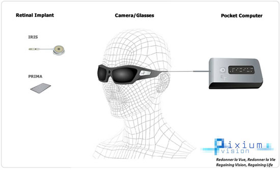 Innovative Medical Devices from Around the World—Pixium Vision