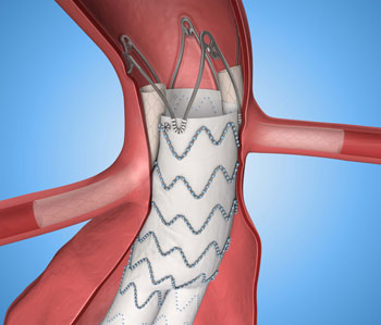 Medtronic's Endurant II Stent Graft Wins Expanded CE Mark Indication