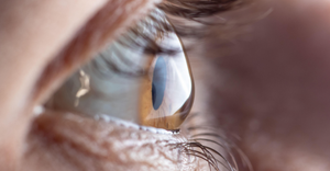macro picture of an eye showing the cornea in the form of a cone, indicating the disease keratoconus