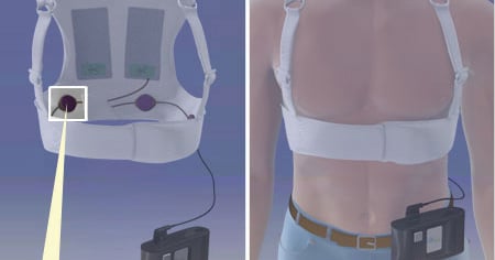 Defib Jacket Wearable Defib Vest Shows Promise, Says AHA