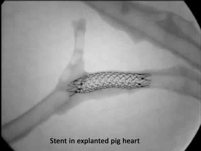 Stent-in-pig-heart-web.jpg