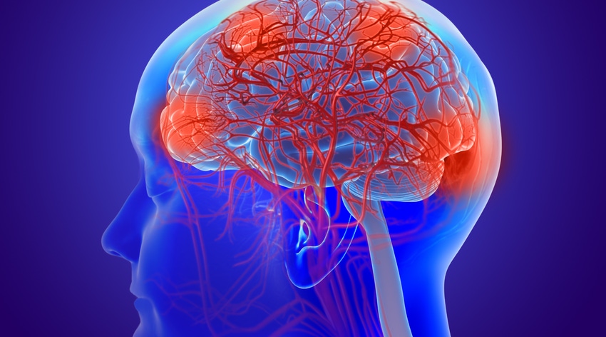 3D illustration of a human brain with Alzheimer's disease / dementia