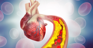 3D illustration showing cholesterol plaque in a coronary artery