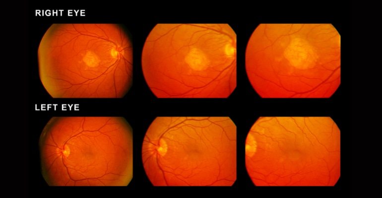 Fundus photos of a right eye and left eye showing age-related macular degeneration (AMD) in both eyes