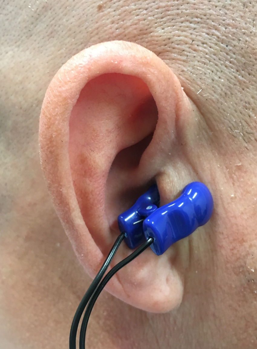HRS: Ear Clip Uses Neurostimulation to Effectively Reduce AFib Burden