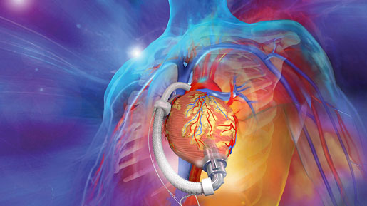 Details on ReliantHeart's Impressive LVAD Technology Cache