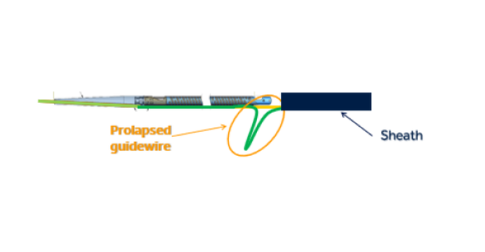 Medtronic recall - diagram of the recalled device showing a prolapsed guidewire within the catheter.