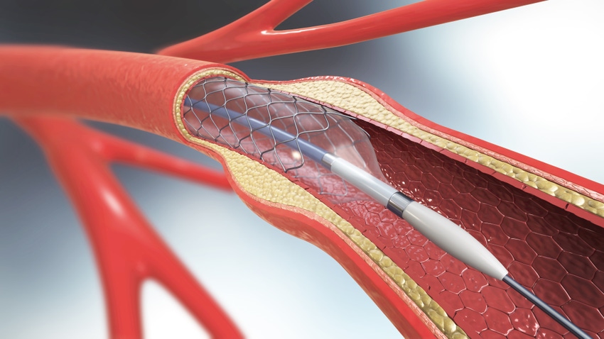 3D illustration of a coronary stent implantation into a coronary artery.