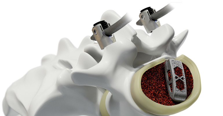 F2　INTEC　TITANFLEX　Lサイズ Medtronic Proves to be a 'Titan' in Spine