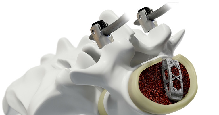 Medtronic Proves to be a 'Titan' in Spine