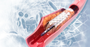3D illustration of a cardiovascular stent on a scientific background