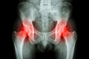 FDA: Metal-on-Metal Hips Must Have PMA