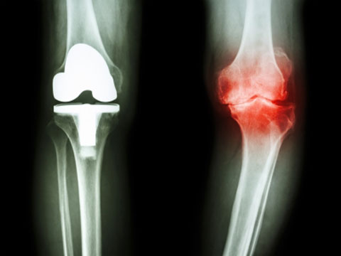 Medicare Bundled Payments Coming to Hip and Knee Replacements