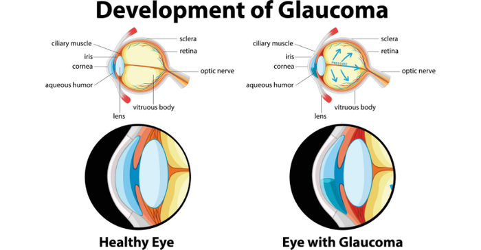diagram showing the development of glaucoma