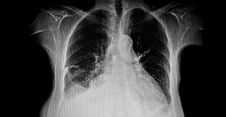 Pleural Effusion