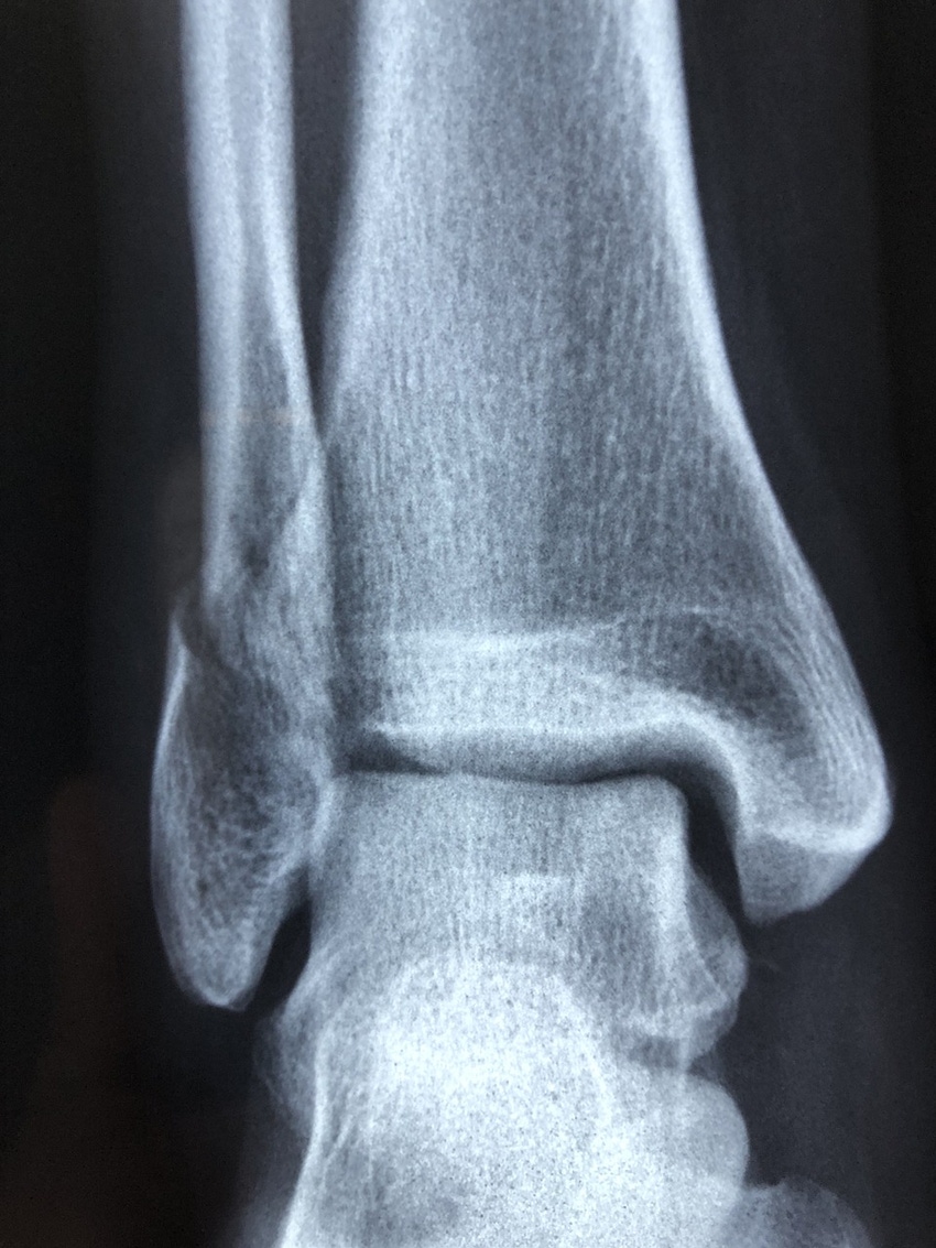X-Rays Imaging Uses Color to ID Bone Fractures