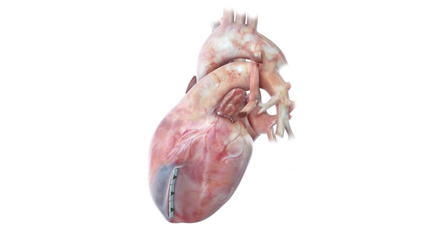 BioVentrix Has Developed a Unique Way to Improve Heart Functionality