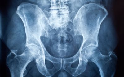Build Strong Bones Early To Evade Osteoporosis, Low Bone Mass Later