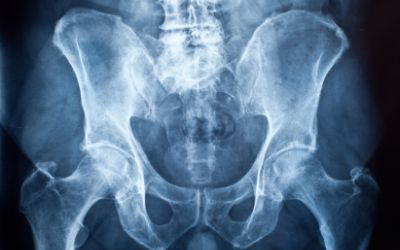 Strengthening Bones for a Lifetime Strengthening Bones for a Lifetime