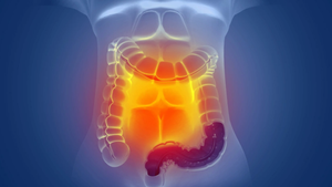 Israeli company's AI-powered gastrointestinal tool can spot many more lesions during colonoscopies.