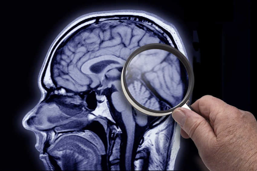 Image shows an MRI image of brain showing area of Alzheimer patient.