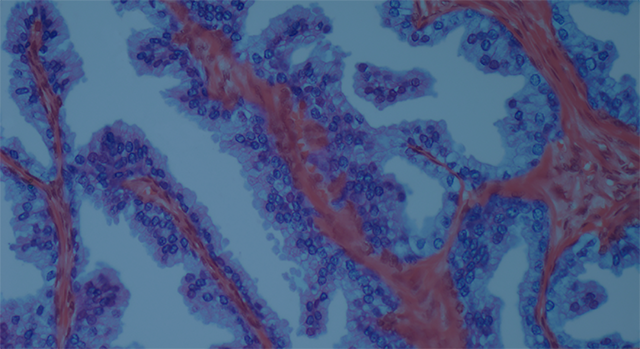 Man sieht eine mikroskopische Ansicht von Prostatakrebszellen. 