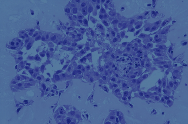 Man sieht eine mikroskopische Ansicht von Lungenkrebszellen.