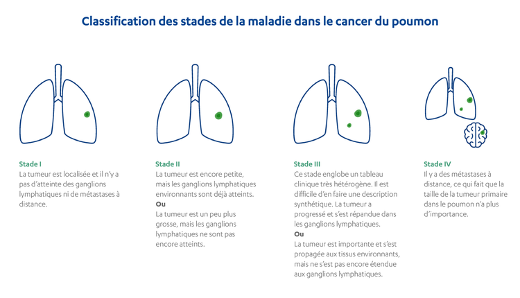 CH-FR-cancer-du-poumon-classification-des-stades-de-la-maladie-dans-le-cancer-du-poumon