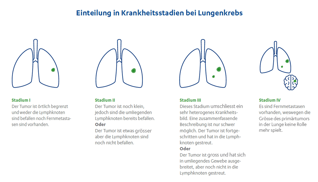Wie Stirbt Man Bei Lungenkrebs