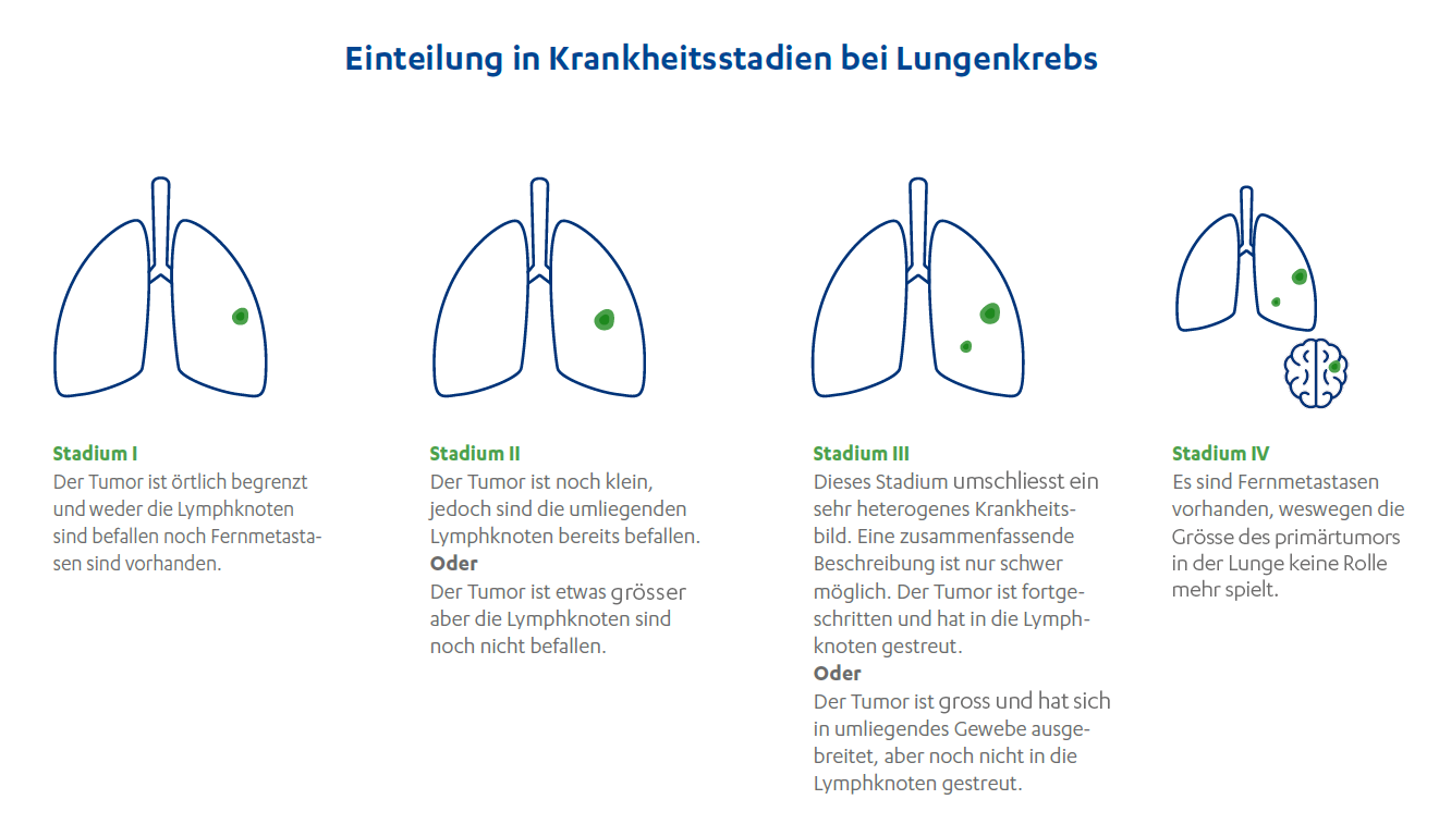 CH-DE-lungenkrebs-einteilung-in-krankheitsstadien-bei-lungenkrebs-ubersicht-der-stadien-bei-lungenkrebs