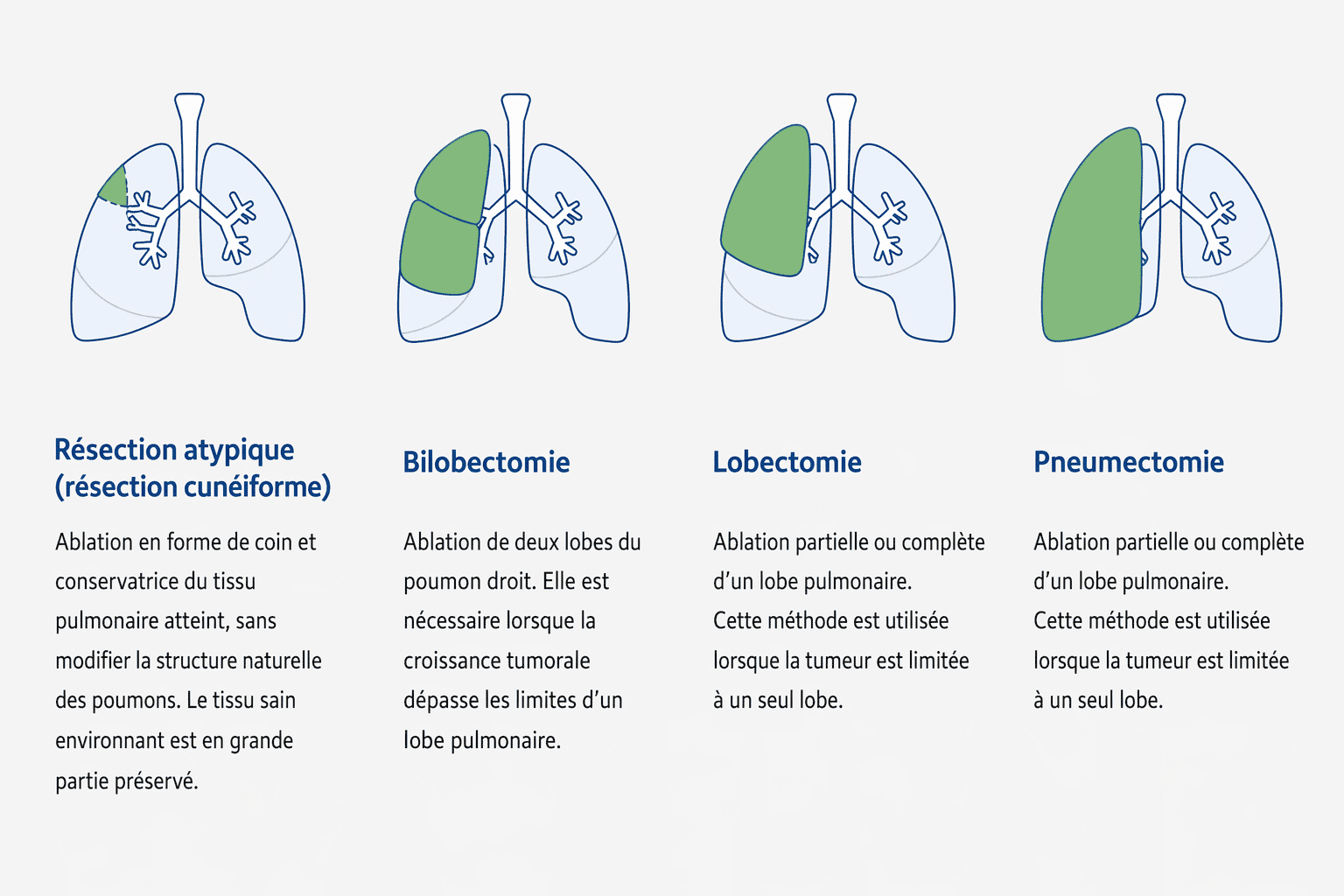 Les quatre méthodes chirurgicales les plus courantes en cas de cancer