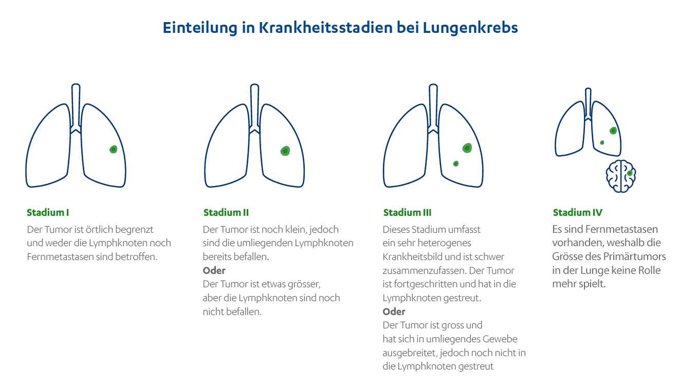 Übersicht der Stadien bei Lungenkrebs