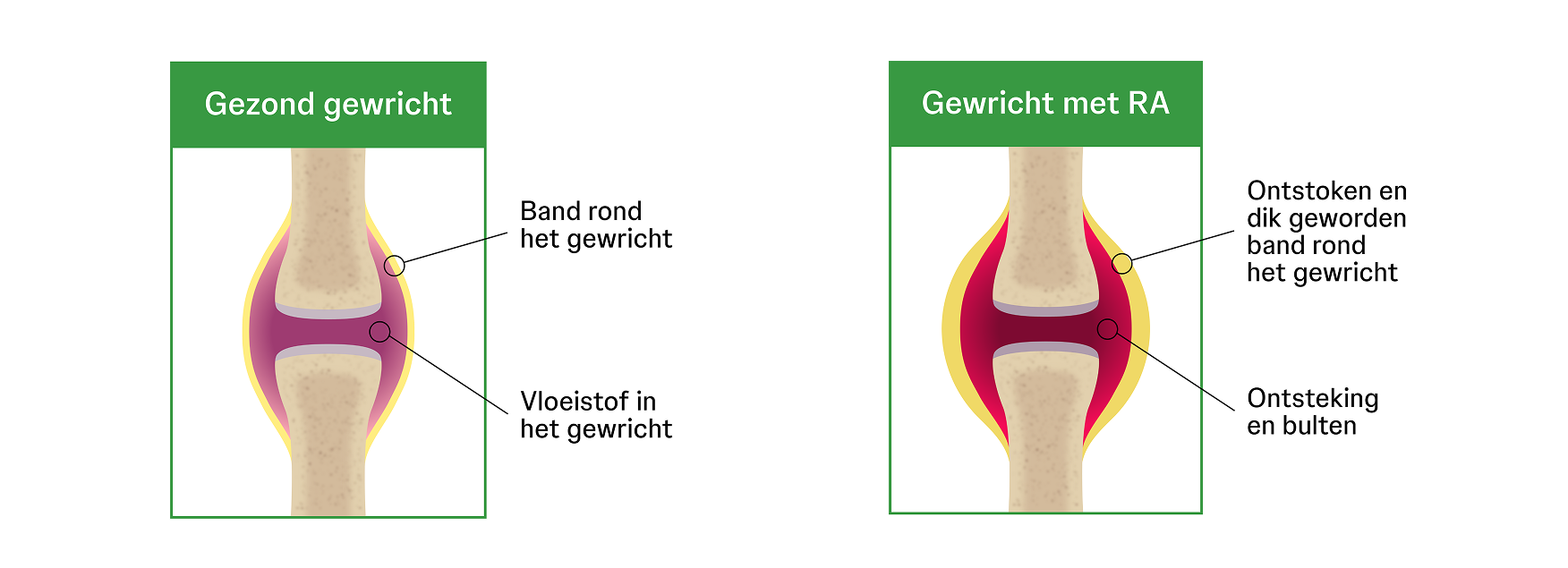 Joint with and without RA