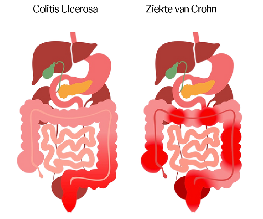 Colitis-Ulcerosa & Ziekte-van-Crohn Colitis Ulcerosa & Ziekte van Crohn