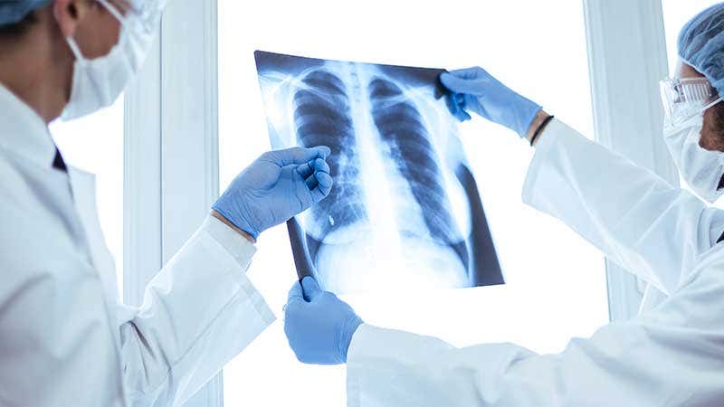 Carcinomas de células pequeñas o microcíticos (CPCP)