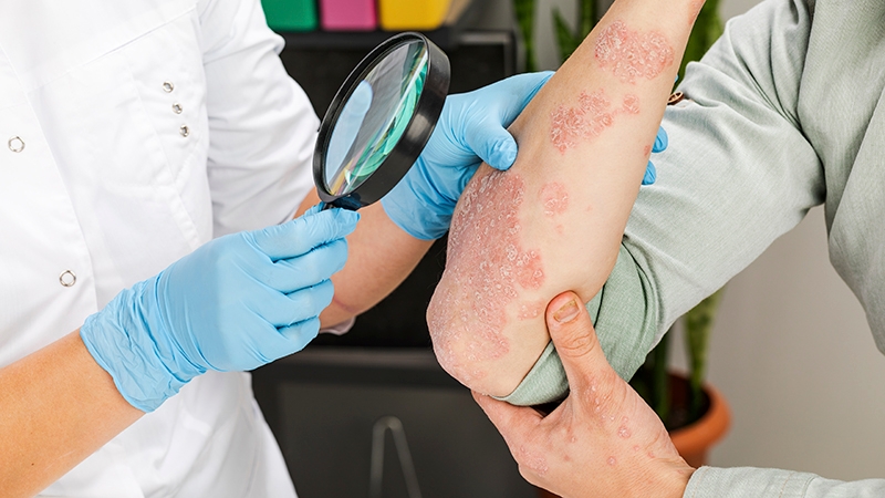 La visibilidad de la enfermedad puede ser una de las repercusiones psicosociales de la psoriasis