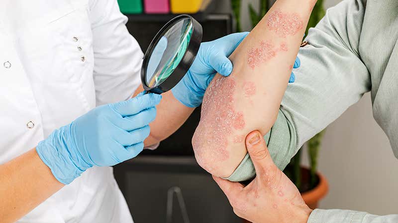 La visibilidad de la enfermedad puede ser una de las repercusiones psicosociales de la psoriasis