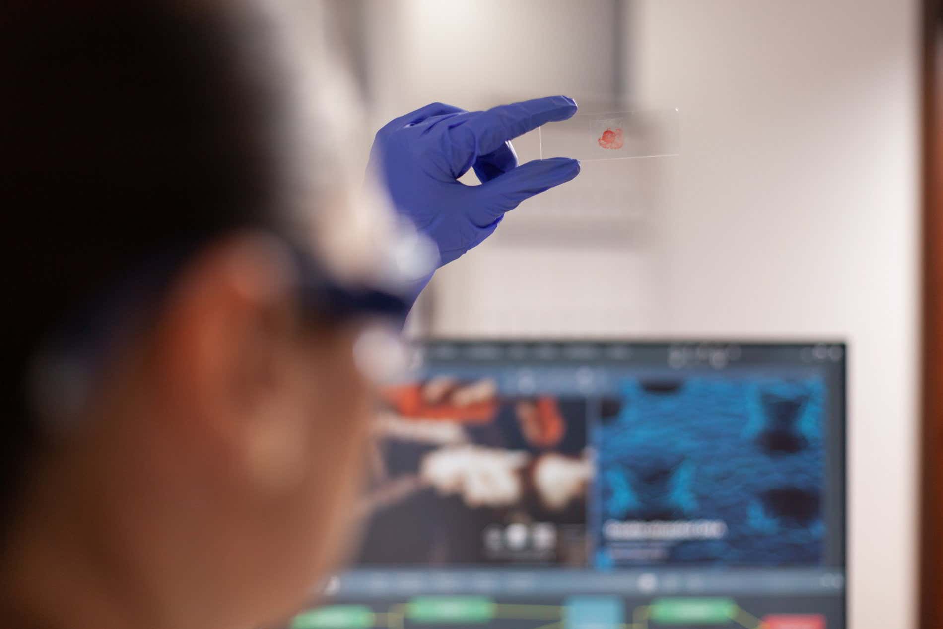 El sistema Rai sirve para dividir en 5 etapas diferentes la leucemia linfocítica crónica