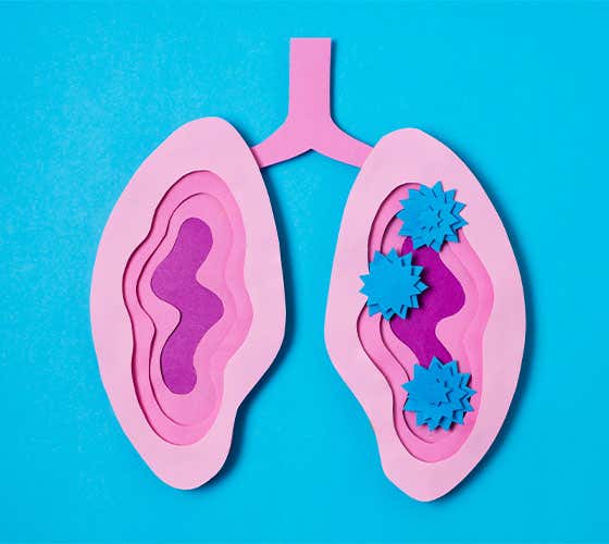 Líneas de tratamiento del cáncer de pulmón.
