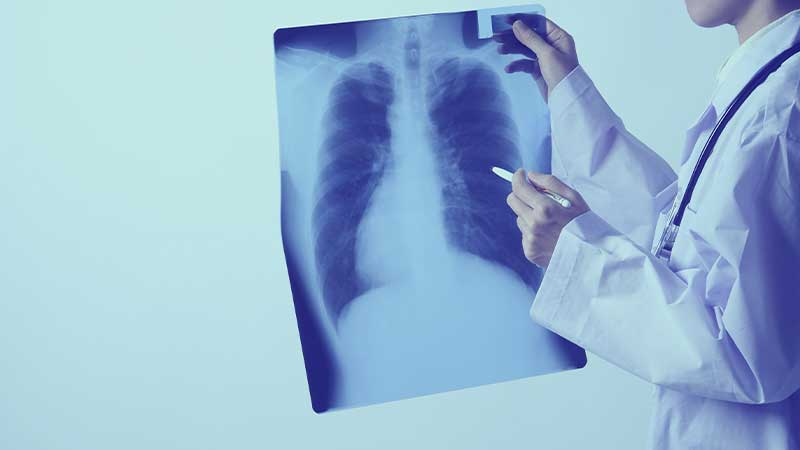 Diagnóstico de una cáncer de pulmón: radiografía