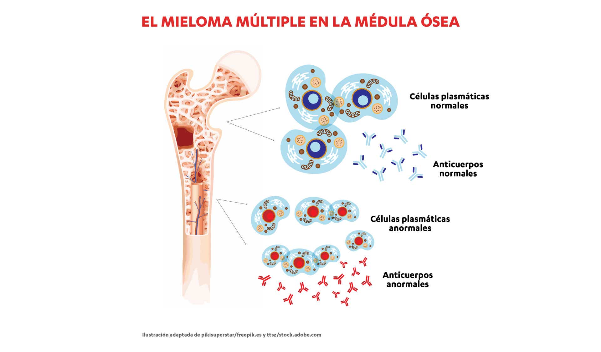 Cuando las células plasmáticas crecen de forma descontrolada y se convierten en cancerosas, dan lugar al mieloma múltiple