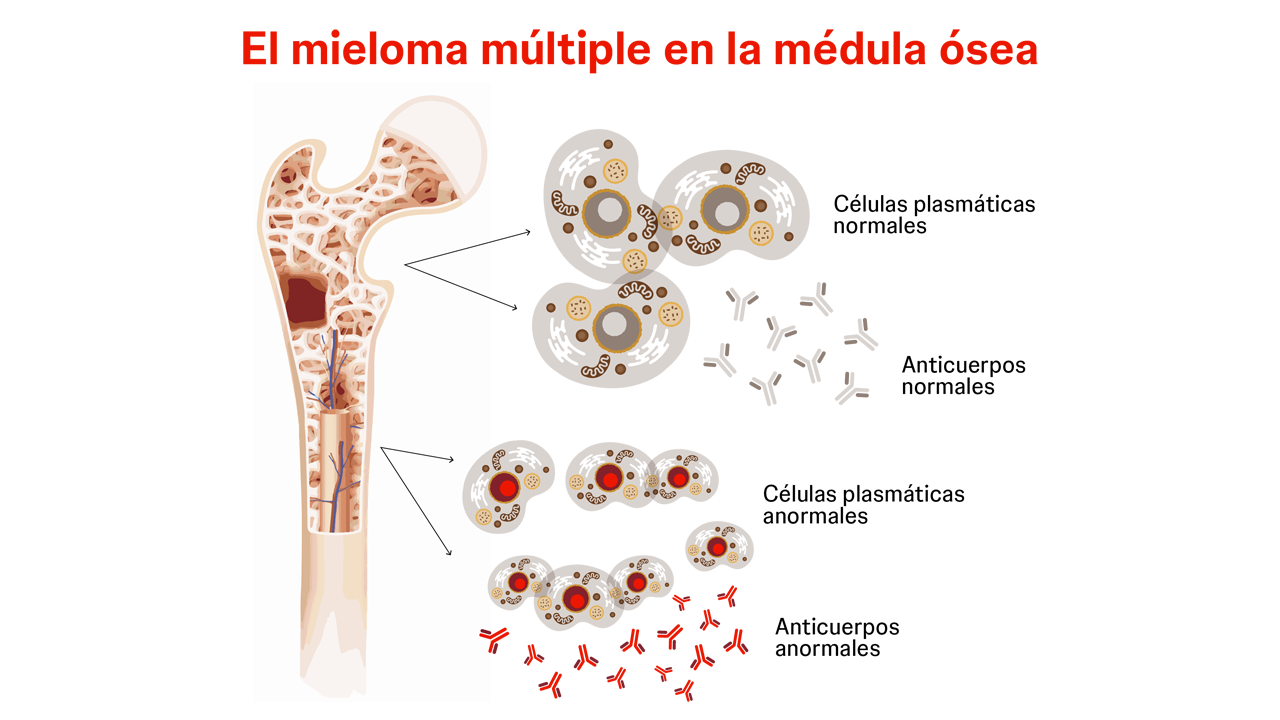 Medula ósea mieloma múltiple Cuando las células plasmáticas crecen de forma descontrolada y se convierten en cancerosas, dan lugar al mieloma múltiple