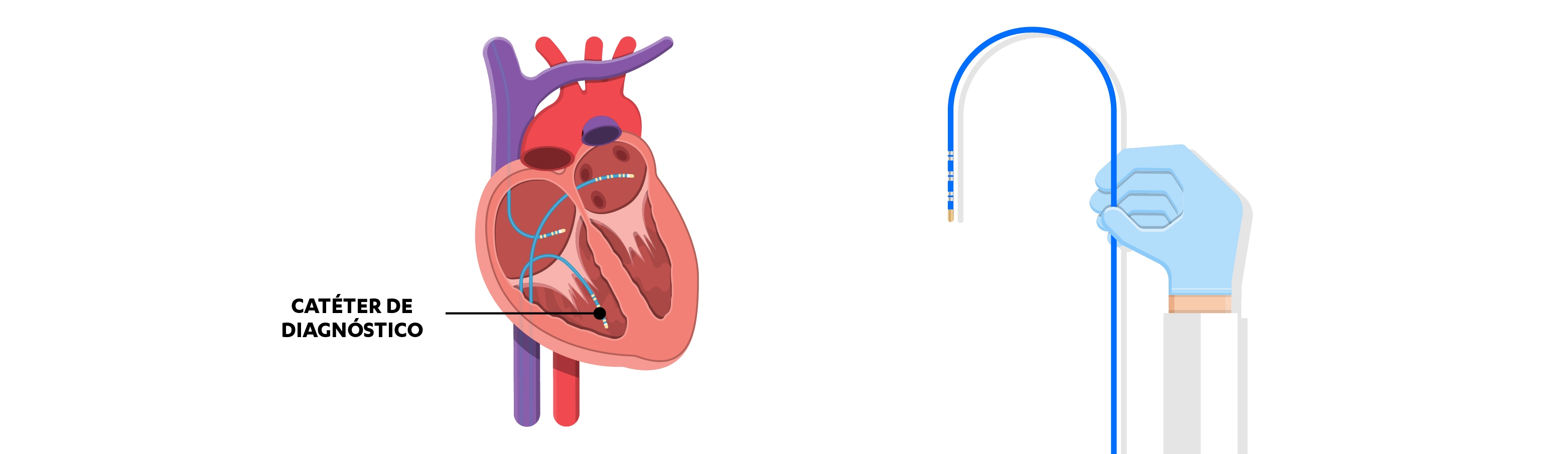El cateterismo cardiaco es necesario en todas las personas con sospecha de hipertensión arterial pulmonar